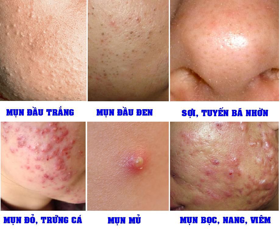 Phân biệt các loại mụn thường gặp