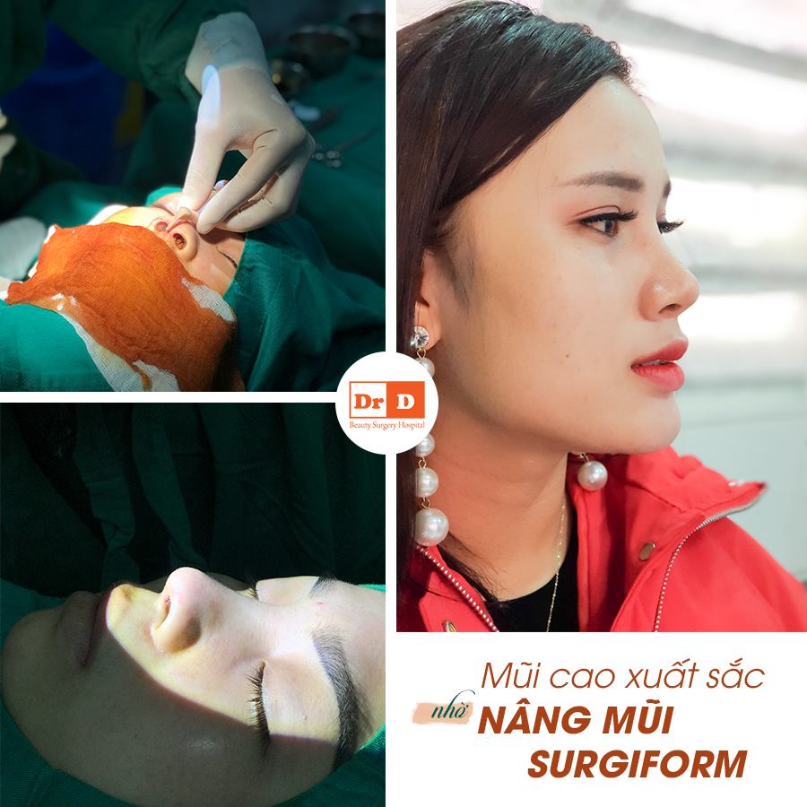 Nâng mũi cấu trúc kết hợp sụn Surgiform - Đẹp cao sang