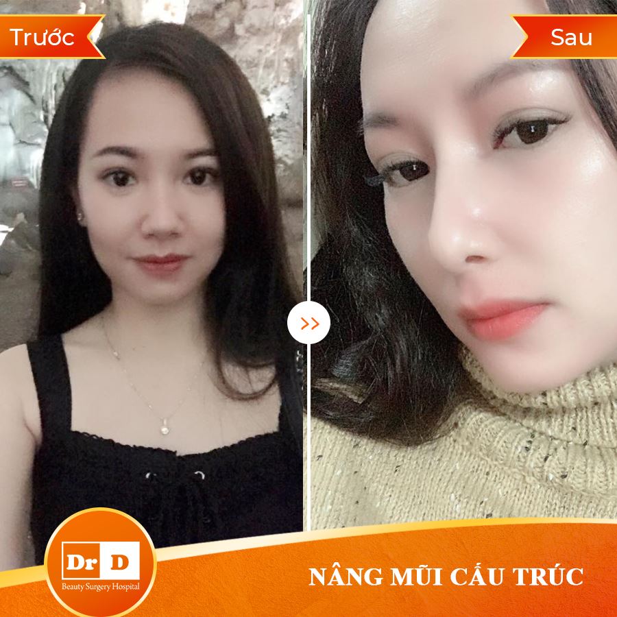 Nâng mũi cấu trúc chỉnh sửa toàn bộ dáng mũi nguyên thủy