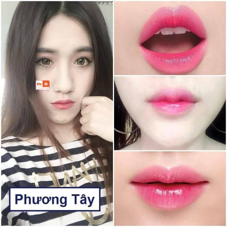Khách hàng Phương Tây rất hài lòng với màu môi mới sau khi phun môi tại Thẩm mỹ DrD