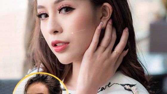 Tiêm Filler - Trào lưu làm đẹp chưa bao giờ hết nhiệt