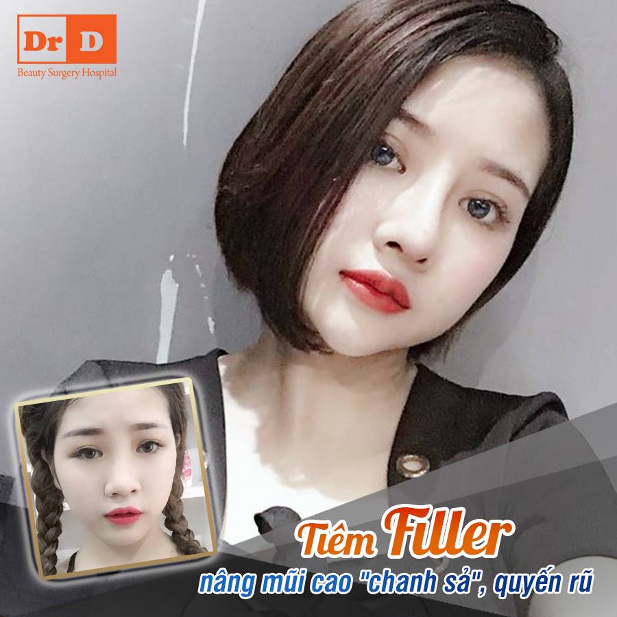 Muốn nâng mũi bằng Filler an toàn hãy đến với Thẩm mỹ DrD